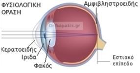 προσαρμογής του ανθρώπινου οφθαλμού είναι η αιτία για την εξασθένηση της όρασης, αφού δεν πραγματοποιείται κατάλληλη εστίαση ανάλογα με την απόσταση του έκαστου υπό εξέταση αντικειμένου. Γ.