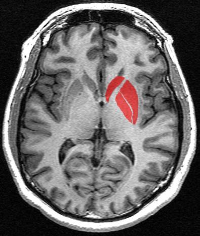 imaging (Parkinson
