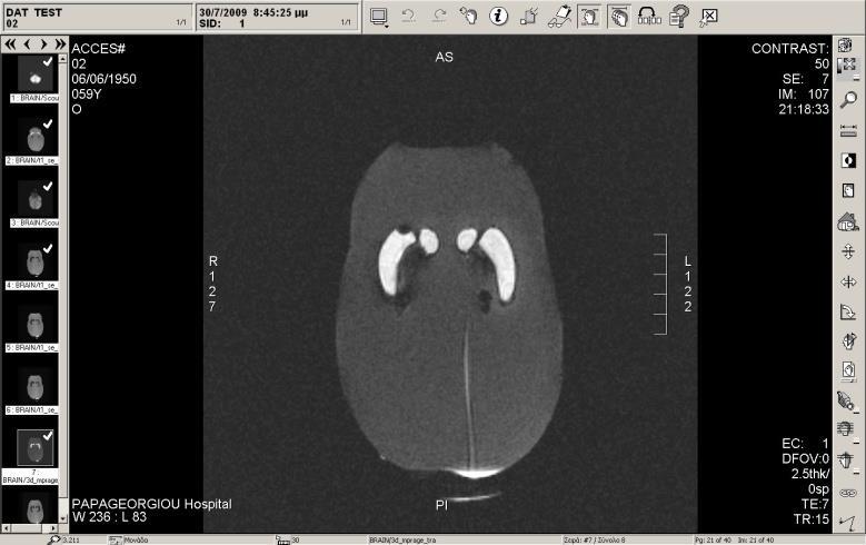 Phantom MRI Spin echo