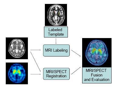 MRI-SPECT image