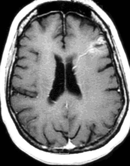 κοιλίας(εικόνα 7), ενώ η αμέσως επόμενη συχνότερη εντόπιση, είναι η παρεγκεφαλίδα(εικόνα 8). Συνοψίζοντας τα φλεβικά αγγειώματα τα συναντάμε παντού στο ΚΝΣ και ειδικά: 1.