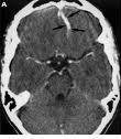 CT χωρίς σκιαγραφικό δείχνει μικρή εστία αιμορραγίας στο δε ημισφαίριο της παρεγκεφαλίδας. Ακολούθησε β.