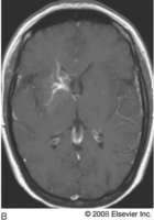 Εικόνα 19. T1 ακολουθία με σκιαγραφικό όπου είναι εμφανής η μεγάλη φλέβα απορροής του DVA, η οποία παροχετεύεται στον άνω οβελιαίο κόλπο. (REF:medscape: Brain imaging in Venous Vascular Malformations.