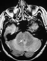 Η παρεγχυματική ανωμαλία τυπικά δεν είναι ορατή.(ref: medscape: Brain imaging in Venous Vascular Malformations. Author:Andrew L. Wagner, MD;Chief editor:james Smirniotopoulos, MD.