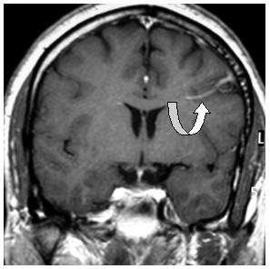 Εικόνα 28 Εικόνα 28: a) (πάνω αριστερά): εγκάρσια MRI με σκιαγραφικό γαδολίνιο δείχνει ένα φλεβικό αγγείωμαλοξά βέλη- στον