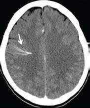 A. B. C. D. REF: Concepts and controversies in the management of cerebral DVA.