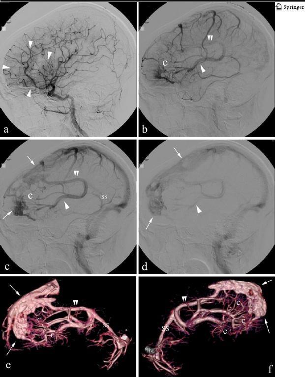(2010) 26:1395-1406.Springer-Verlag 2010 Childs Nerv Syst ΕΙΚΟΝΑ 40.Μια 20χρονη γυναίκα διερευνάται για κρανιοφαρυγγίωμα και στην MRI απεικονίστηκε ένα μεγάλο, πολύπλοκο DVA.