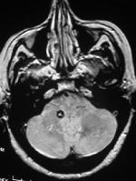 Ref: Medscape/Brain imading in venous nascular malformations. ΕΙΚΟΝΑ 43.