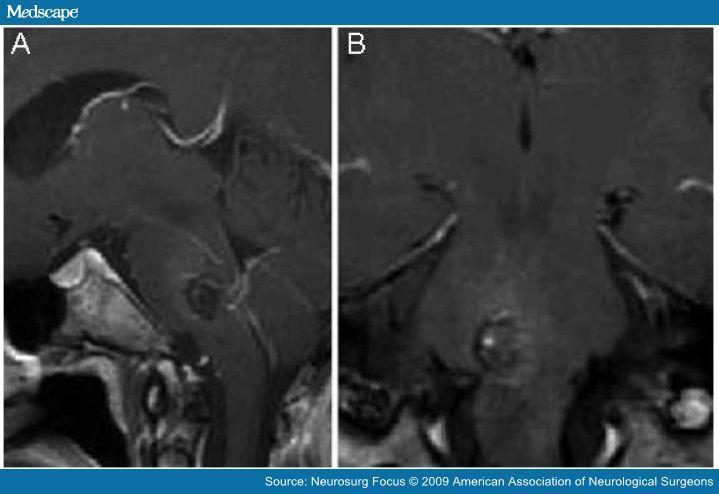 Εικόνα 48: SP σε απλή ακτινογραφία κρανίου(a), σε CT μετά χορήγηση σκιαγραφικού(b), και DSA(c).