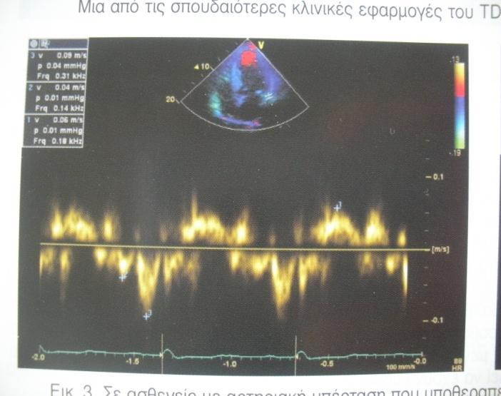 ΚΑΗ ΑΤΞΖΜ ΤΦΟ ΣΟΤ ΚΤΜΑΣΟ Α ΜΔΗΧΖ ΣΟΤ ΛΟΓΟΤ Ε/Α ΚΑΗ ΑΤΞ. ΣΟΤ ΥΡΟΝΟΤ IVRT ΚΑΗ ΠΑΡΑΣΑΖ ΣΟΤ DT >240 msec.