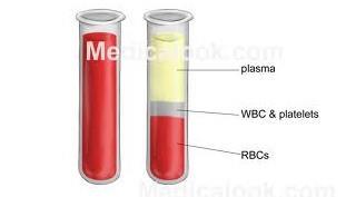 طريقة فصل البالزما (plasma) توضع عينة الدم في أنبوب يحوي أحد مضادات التخثر )ك الهيبارين وسيترات الصوديوم وفلوريد الصوديوم وEDTA ( مما يمنع التخثر )ألن هذه المركبات توقف أنزيمات التخثر( ويبقى
