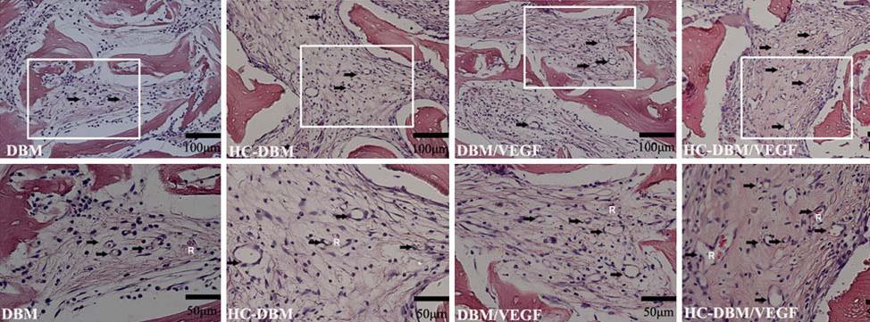razliku od VEGF-A, su ligandi za treći receptor (VEGFR-3), koji podstiče limfoangiogenezu- lymphangiogenesis [168-171].. Sl.