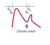 Σφυγµός Χαρακτήρας dicrotic pulse (δίκροτος) Ψηλάφηση κύµατος στη συστολή και διακριτό κύµα (dicrotic wave) στη διαστολή.