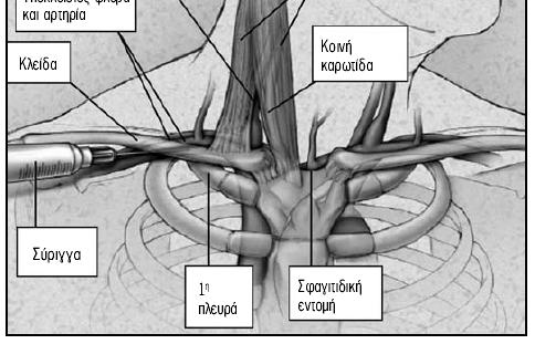 Φλέβα Έσω σφαγίτιδα φλέβα