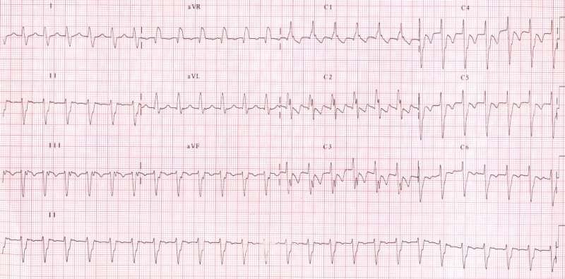 Surface 12 lead ECG during fascicular VT showing a right bundle branch
