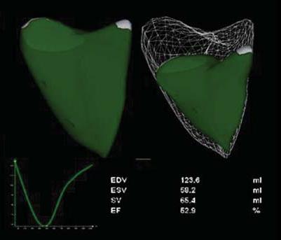 Τρισδιάστατη ηχοκαρδιογραφία (3D echocardiography) Μια