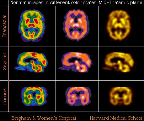 Normali smegenų perfuzija Pacientų be smegenų pažeidimo skenogramose matome bilateraliai simetrišką perfuzijos aktyvumą.