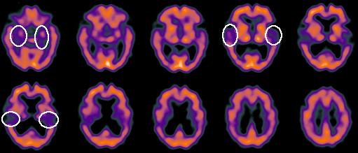 Alzheimerio liga Bilaterlaiai