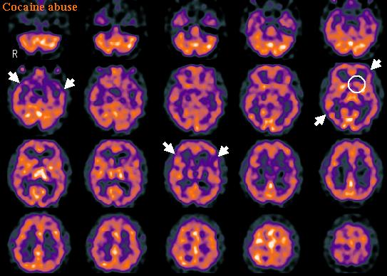 Kokaino vartojimas Bendras smegenų