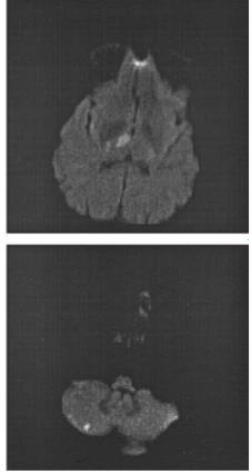 MRI/DWI : υψηλή ευαισθησία Στην οξεία φάση το μέγεθος στην DWI μπορεί να φθάνει τα 20mm Πολλαπλά έμφρακτα μικρού