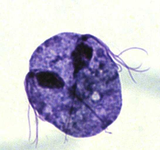 Trichomonas vaginalis Τριχοµονάδα Πρωτόζωα Μέγιστο Μέγεθος (nm).. 10.000 Κρούσµατα ανά έτος.. 143.000.000 Επικινδυνότητα (σχετ.). 3 Η τριχοµονάδωση (ή τριχοµονίαση) είναι η πιο συχνή σεξουαλικώς µεταδιδόµενη ασθένεια.