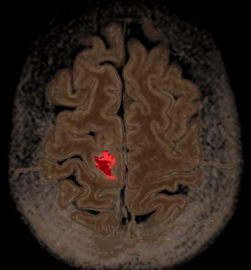 Συγκαταχώρηση εικόνων Tumor Volume Segmentation