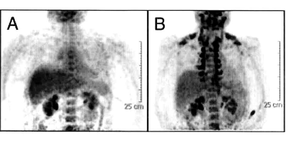 J Clin Endocrinol Metab 2012; 97: E1229-Ε1233 30 Προεγχειρητικά 1 έτος μετά την περίδεση του στομάχου Αύξηση