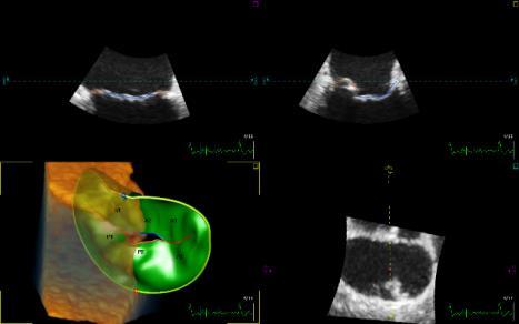 C. MANAGEMENT OF MV REGURGITATION BEFORE and