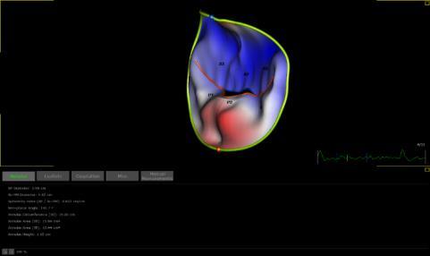 Quantification Semi-automatic software for MV