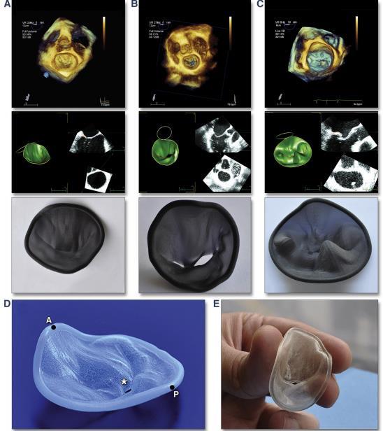 3D PRINTING Patient-specific 3D-printed anatomical models of intracardiac structures using 3D echocardiographic data - Haptic feel and true 3D perspective - Potential applications in cardiac