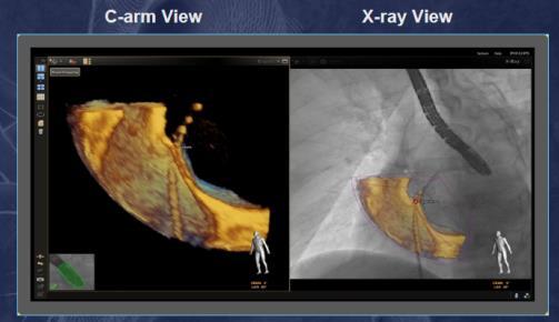 1. Transeptal