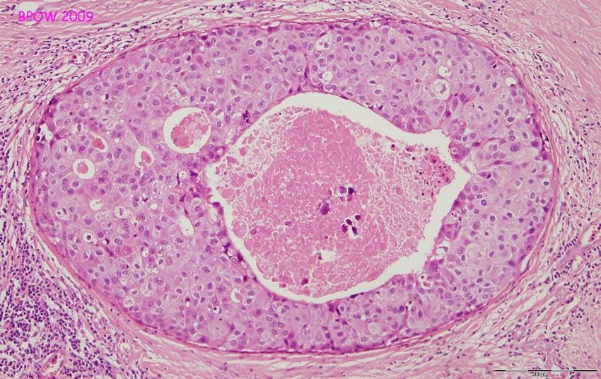 Εικόνα 15. Φαγεσωρικός (comedo) υπότυπος πορογενούς in situ καρκίνου μαστού. www.breastpathology Ο συμπαγής υπότυπος έχει χαρακτηριστικό ότι τα καρκινικά κύτταρα έχουν καταλάβει όλον τον πόρο.