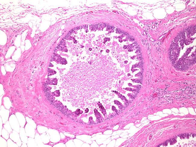 καρκίνου μαστού. http://webpathology.com Εικόνα 19.