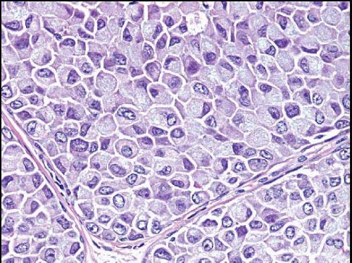Στην περίπτωση που έχουμε πλειόμορφη κυτταρολογική εικόνα, τότε αναφερόμαστε σε LCIS τύπου Β.