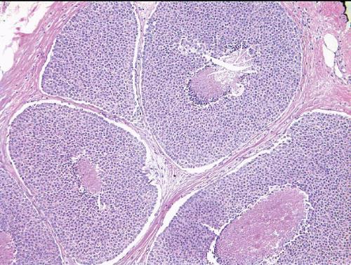 Εικόνα 29. Φαγεσωρικός (comedo) υπότυπος λοβιακού in situ καρκίνου μαστού.