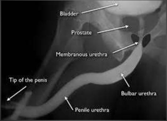 Λήψεις μετά το τέλος της ούρησης - Ανατομικές ανωμαλίες