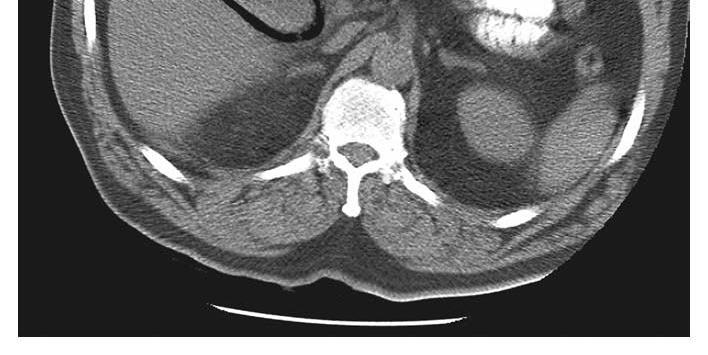 hospital with a 4-day history of increasing abdominal pain,