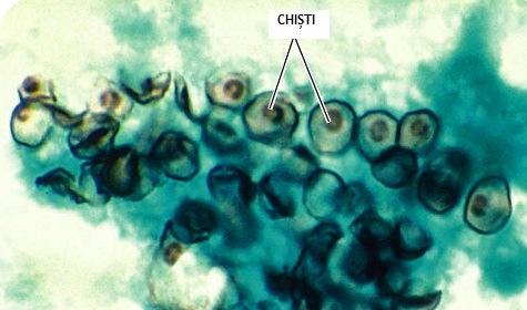 Ciclul evolutiv al Coccidiodes imitis Sursa: http://slideplayer.com/slide/4636317/ Pneumonia pneumocistică (PCP) Produs de micul fung: Pneumocystis jiroveci (P.