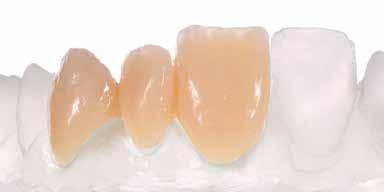 σύνθετου υλικού καλουπιού Dentsply Sirona.