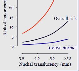 risks: Pieaug, ja ductus venosus plūsma ir reversa Samazinās, ja ductus venosus