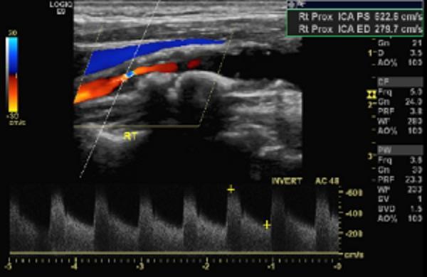 Right PSVcca=95cm/sec