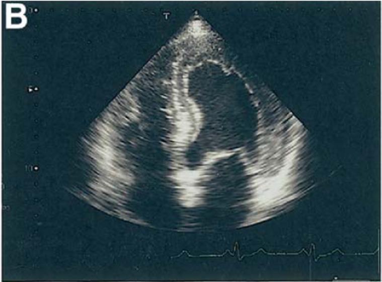 of LV endocardial border,