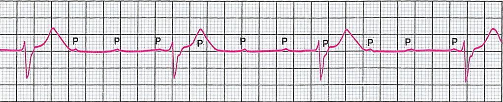 Τούτο αποτελείται από αυτοµατικά κύτταρα µε βηµατοδοτική σταθερότητα και συχνότητα εκποµπής σχετικά υψηλή, 40-50/λή µεγαλύτερη. Τα συµπλέγµατα QRS δεν είναι διευρυσµένα.