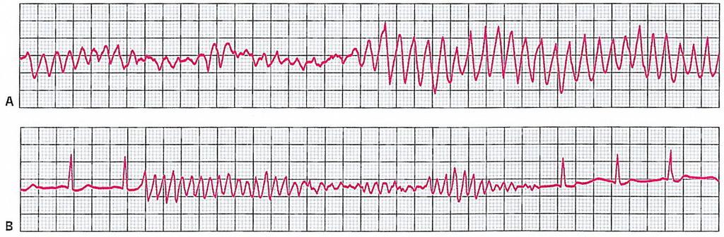 Εικόνα 34: Torsades de Pointes: Α. Πολύµορφη κοιλιακή ταχυκαρδία µε µορφολογία δίκην ριπιδίου. Το ύψος, το εύρος και ο άξονας του συµπλέγµατος QRS µεταβάλλεται ουνεχώς. Β.