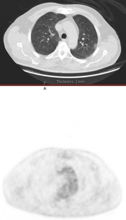 Ασαφής αλλοίωση στο κορυφοπίσθιο στου αριστερού άνω πνευμονικού λοβού Μετά 2