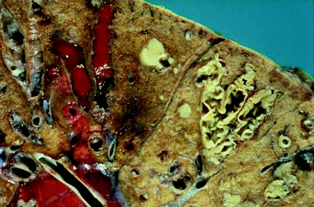 This gross lung specimen from a patient with CF demonstrates the pathology of bronchiectasis, as follows: dilated peripheral