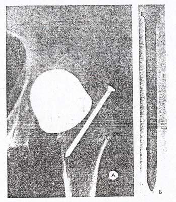 Figura 5-17. Coroziune datorată folosirii improprii a metalelor. A. Radiografia unei artroplastii a unui şold turnat dintr-un aliaj CoCrMo.