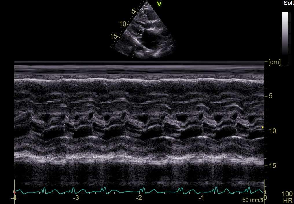 Εικόνα parasternal long axis M-mode: Πλήρες SAM της πρόσθιας