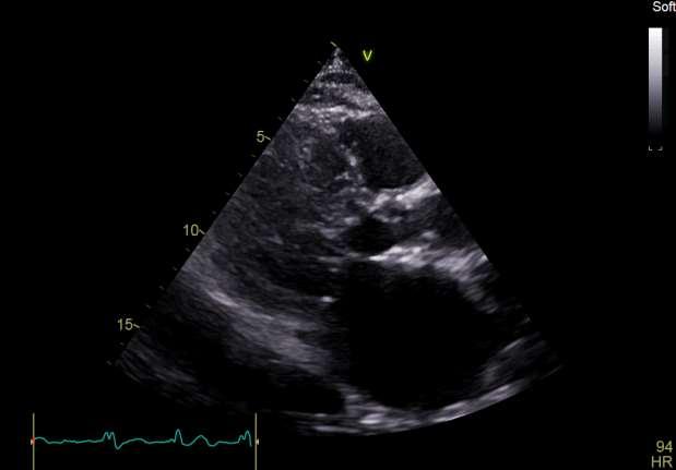 Διαθωρακικό υπερηχογράφημα Parasternal long axis: Τελοδιαστολική/τελοσυστολική διάμετρος αριστερής κοιλίας φυσιολογικών διαστάσεων, συγκεντρική υπερτροφία