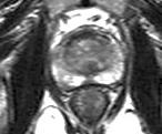 15/1/2018 Απεικόνιση του προστάτη στην MRI Η περιφερική ζώνη δεικνύει υψηλό MR σήμα εξαιτίας της μεγάλης